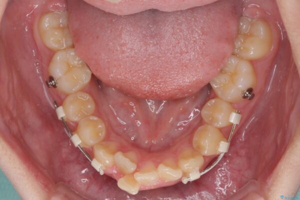 下の前歯が隠れてしまうほど深い咬み合わせ　高校生のインビザライン矯正治療 治療途中画像