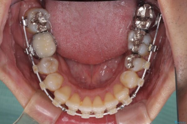 受け口傾向の咬み合わせ　前歯のデコボコをワイヤー矯正で素早く改善 治療途中画像