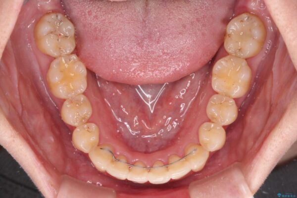 上下前歯のデコボコをきれいに　インビザラインによる矯正治療 治療後画像
