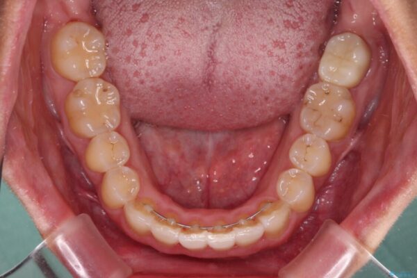 前歯のデコボコをインビザラインでスッキリと仕上げる 治療後画像
