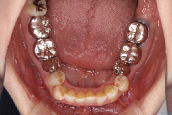 奥歯の銀歯と歯並びを改善　歯周外科治療と矯正治療を行った総合歯科診療 治療前画像