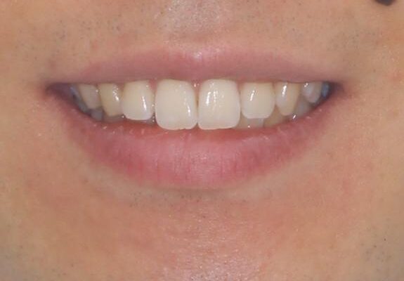 前歯のデコボコと突出感　インビザラインにて矯正治療 治療前画像