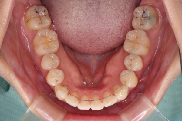 内側にある歯が邪魔　重なった前歯の歯列矯正 治療後画像