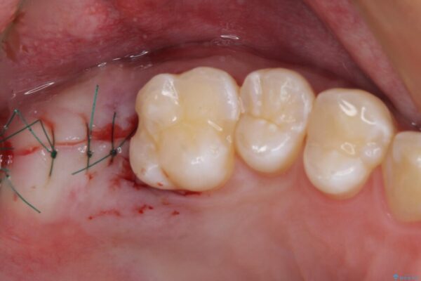 歯に穴を開けられてしまった　インプラントによる奥歯の補綴治療 治療途中画像
