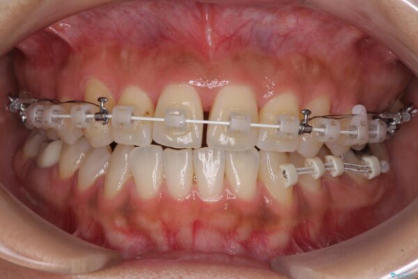 【モニター】幅の狭い上顎歯列　骨幅を拡大する矯正治療 治療途中画像