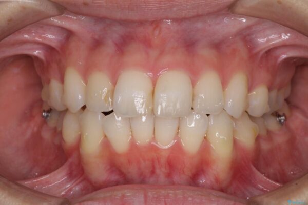 【モニター】前歯のデコボコをインビザラインできれいに整える 治療途中画像