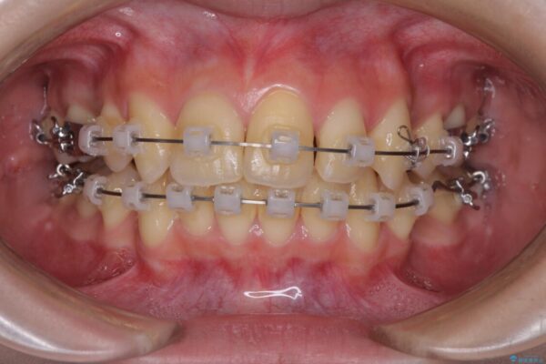 出っ歯を治したい　ワイヤー装置による抜歯矯正 治療途中画像