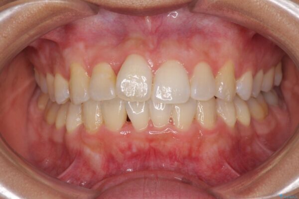 前歯のデコボコをインビザラインでスッキリと仕上げる 治療途中画像