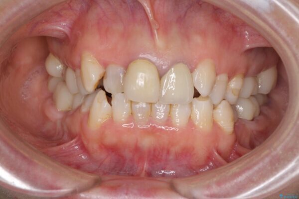 奥歯の銀歯と歯並びを改善　歯周外科治療と矯正治療を行った総合歯科診療 治療途中画像