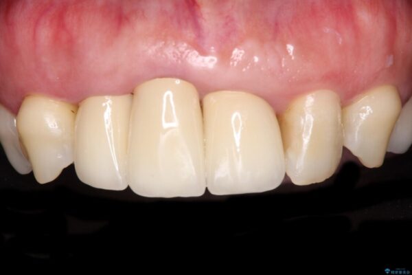 歯茎の縁に見える変色を隠したい　前歯のオールセラミッククラウン アフター