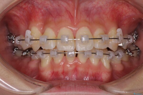 前歯の歯並びを治したい　ワイヤー装置での抜歯矯正 治療途中画像