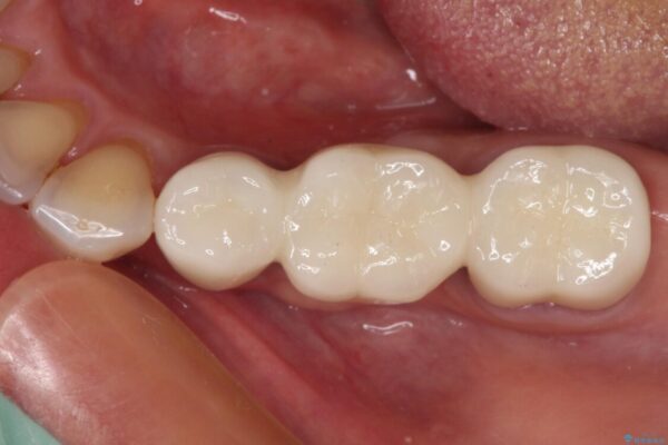 抜かずに保存した奥歯が痛くて臭う　セラミックブリッジによる欠損補綴治療 アフター