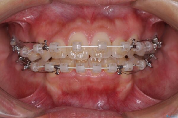 気になる八重歯を治したい　目立たないワイヤーでの抜歯矯正 治療途中画像