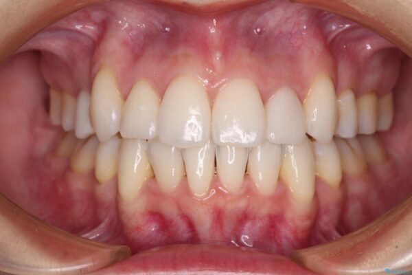 結婚式までに前歯をきれいにしたい　抜歯矯正とオールセラミッククラウン 治療後画像