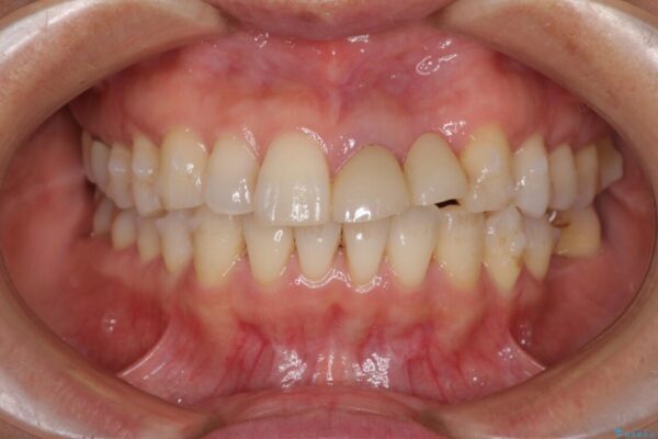 口元の突出感を治したい　治療中の歯も治したい 治療途中画像