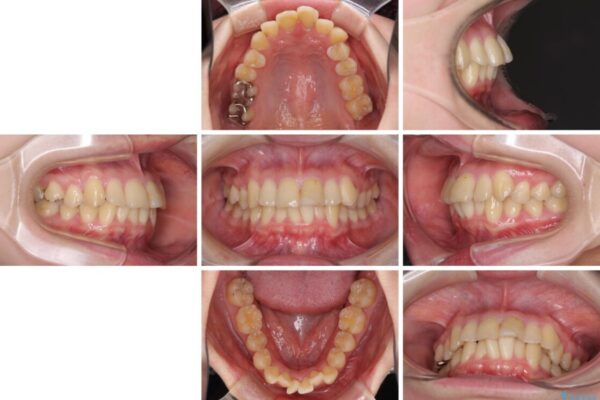 上下前歯のデコボコをきれいに　インビザラインによる矯正治療 治療前画像