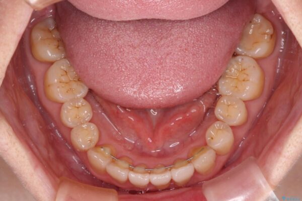 前歯のクロスバイトを治したい　インビザラインによる矯正治療 治療後画像