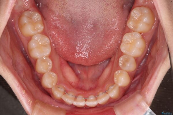 上顎骨拡大を用いたインビザラインによる非抜歯矯正 治療後画像