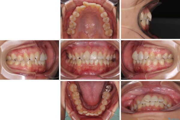前歯のデコボコをインビザラインでスッキリと仕上げる 治療前画像