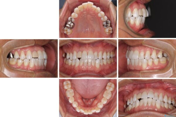 治療途中の前歯を治したい　インビザライン矯正とオールセラミッククラウン 治療前画像