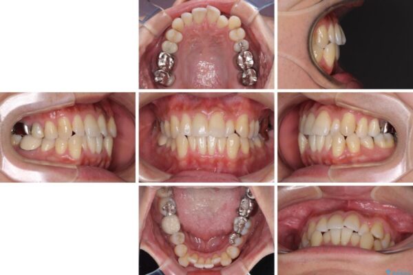 受け口傾向の咬み合わせ　前歯のデコボコをワイヤー矯正で素早く改善 治療前画像