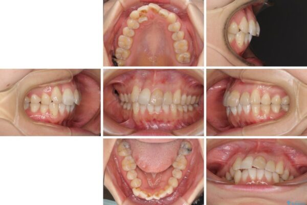 内側にある歯が邪魔　重なった前歯の歯列矯正 治療前画像