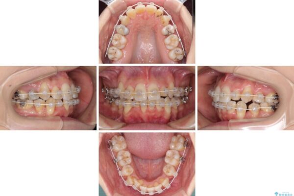 結婚式までに前歯をきれいにしたい　抜歯矯正とオールセラミッククラウン 治療途中画像