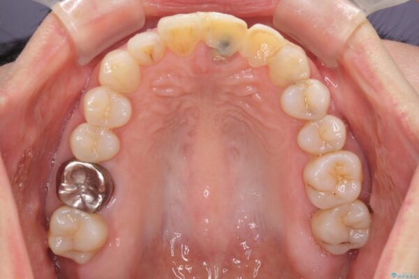 口元の突出感を治したい　治療中の歯も治したい 治療前画像