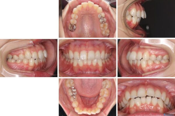 【モニター】前歯のデコボコをインビザラインできれいに整える 治療前画像