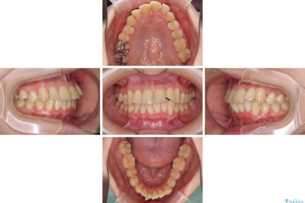 上下前歯のデコボコをきれいに　インビザラインによる矯正治療 治療途中画像