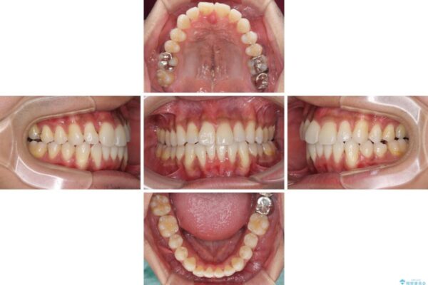 上顎の狭い歯列をインビザラインで拡大 治療途中画像