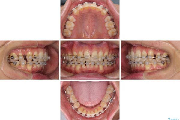 掃除しにくい前歯と閉じにくい口元　目立たないワイヤー装置での抜歯矯正 治療途中画像