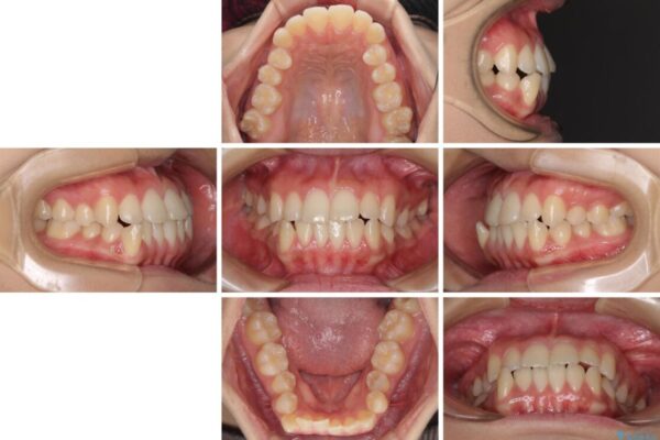 上顎骨拡大を用いたインビザラインによる非抜歯矯正 治療前画像