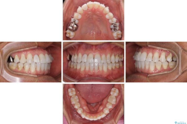 治療途中の前歯を治したい　インビザライン矯正とオールセラミッククラウン 治療途中画像