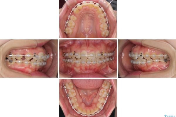変則的な抜歯矯正　八重歯を抜いてしまった人のワイヤー矯正 治療途中画像