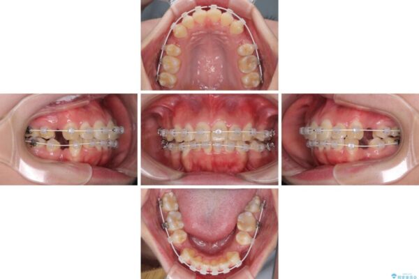 前歯の出っ歯と口の閉じにくさを抜歯矯正で改善　目立たないワイヤー矯正 治療途中画像