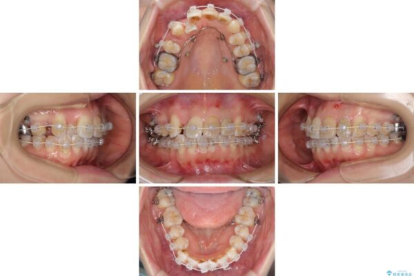 内側にある歯が邪魔　重なった前歯の歯列矯正 治療途中画像