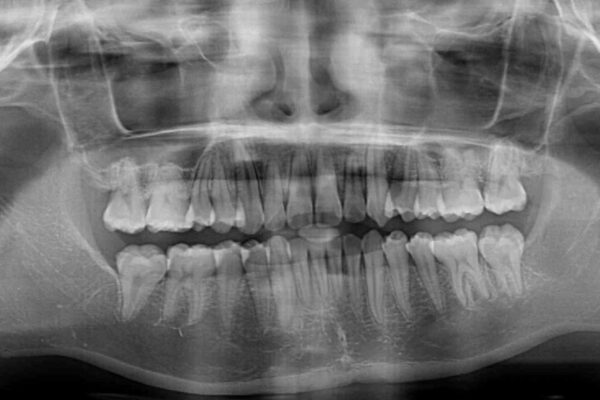 【モニター】犬歯のクロスバイトを目立たないワイヤー装置で 治療後画像