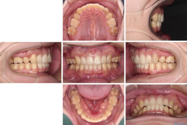 気になる八重歯を抜歯矯正で改善　補助装置を用いたインビザライン矯正 治療後画像