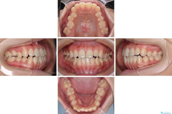 上顎骨拡大を用いたインビザラインによる非抜歯矯正 治療途中画像