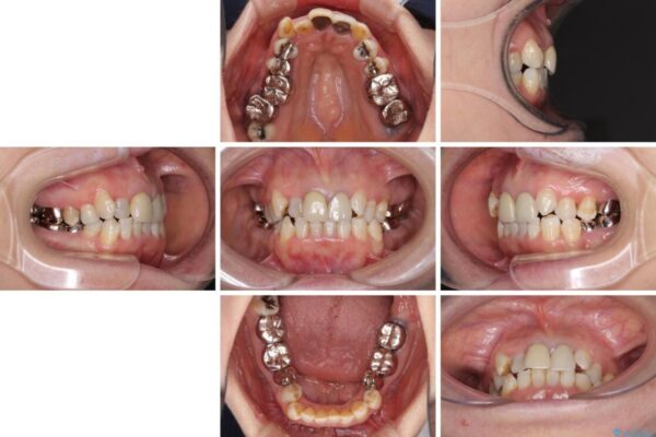 奥歯の銀歯と歯並びを改善　歯周外科治療と矯正治療を行った総合歯科診療 治療前画像