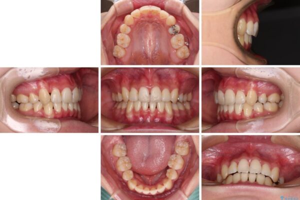 前歯の歯並びを治したい　ワイヤー装置での抜歯矯正 治療後画像