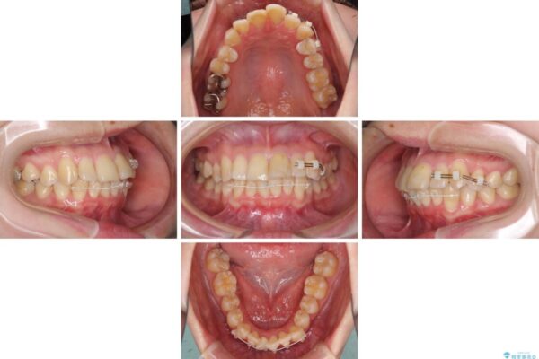 上下前歯のデコボコをきれいに　インビザラインによる矯正治療 治療途中画像