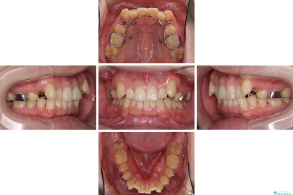 気になる八重歯を抜歯矯正で改善　補助装置を用いたインビザライン矯正 治療途中画像