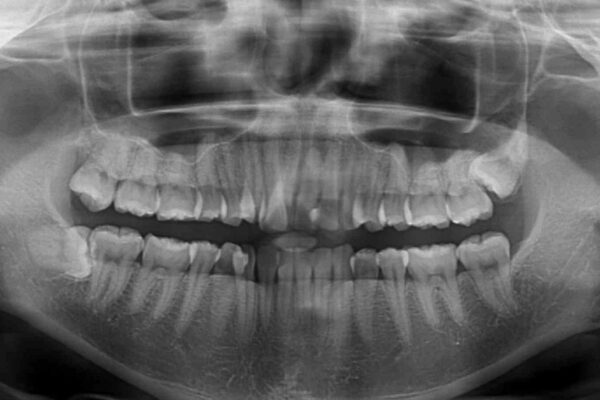 内側にある歯が邪魔　重なった前歯の歯列矯正 治療前画像
