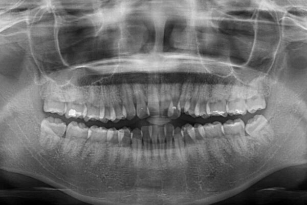 気になる八重歯を治したい　目立たないワイヤーでの抜歯矯正 治療前画像