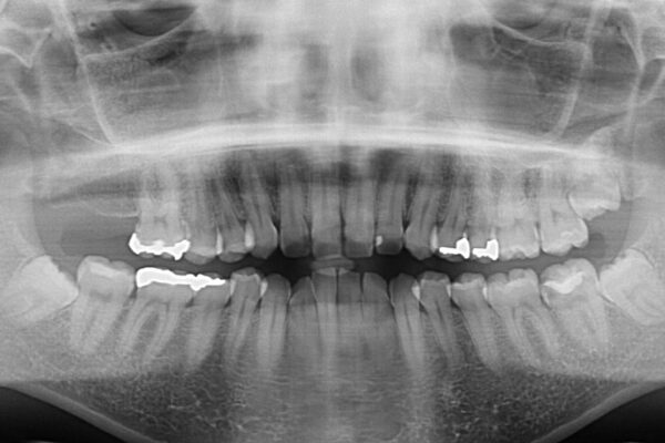 【モニター】前歯のデコボコをインビザラインできれいに整える 治療前画像