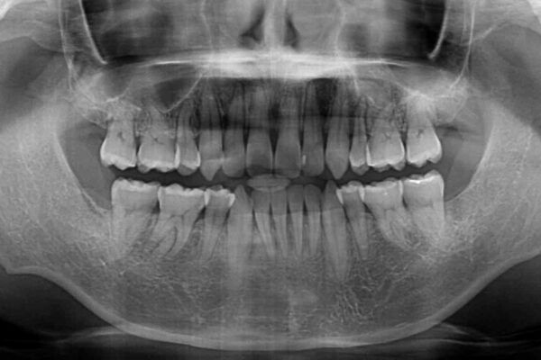 掃除しにくい前歯と閉じにくい口元　目立たないワイヤー装置での抜歯矯正 治療後画像