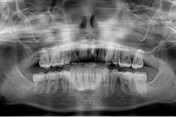 出っ歯を治したい　ワイヤー装置による抜歯矯正 治療後画像