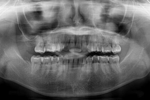 変則的な抜歯矯正　八重歯を抜いてしまった人のワイヤー矯正 治療後画像